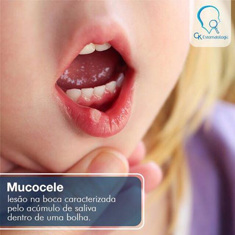 Mucocele